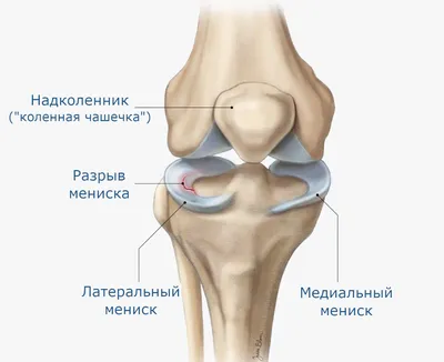 Все о разрыве мениска колена - причины, симптомы, кто лечит