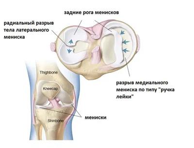 Повреждение (разрыв) мениска коленного сустава: симптомы и лечение, причины,  диагностика и профилактика. | Дмитрий | Дзен