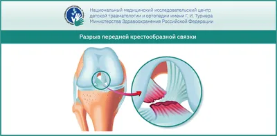 МРТ-диагностика разрывов менисков коленного сустава