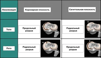 Восстановление мениска артроскопическим методом, операция на мениске |  ortoped-klinik.com