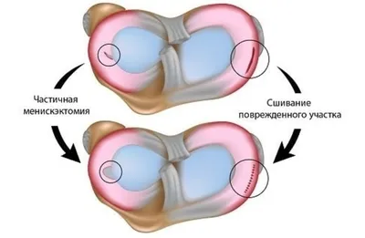 Повреждения коленного сустава: травмы мениска, повреждения ПКС у детей и  подростков