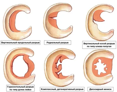 Разрыв мениска. Лечение без операции. - YouTube