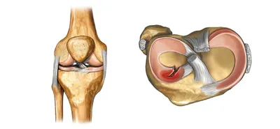 Лечение разрыва мениска бесплатно по ОМС