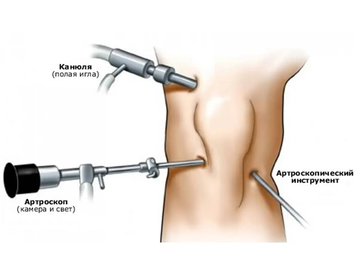 Операция через отверстие. Операция артроскопия коленного сустава. Разрыв мениска артроскопия.