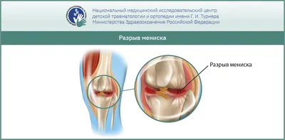 Артроскопия - эндоскопическая операция при разрыве мениска