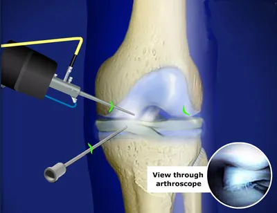 Лечение Повреждение мениска - Ортопедия Руслана Сергиенко