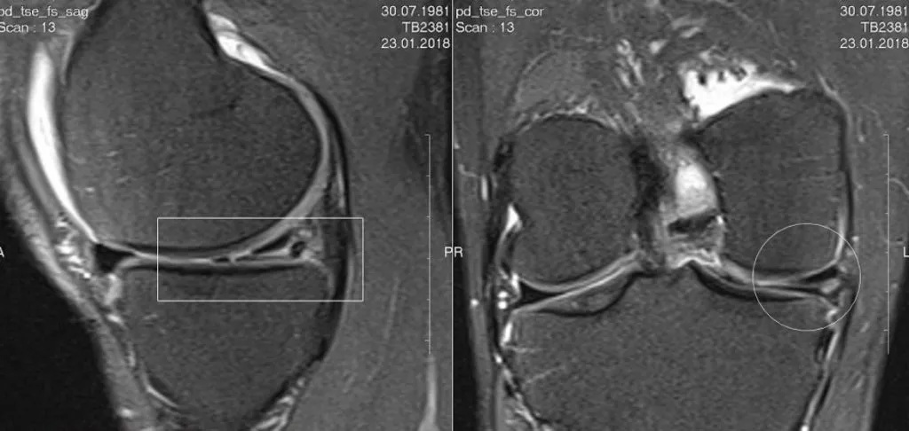 Лечение мениска коленного