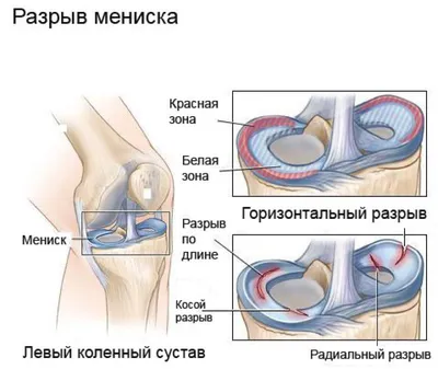 Мениски - причины повреждения