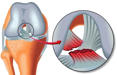 Разрыв связок колена фото