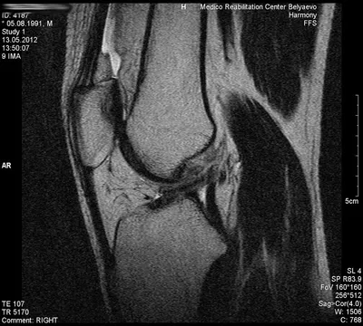 Разрывы передней крестообразной связки - Клиника 29