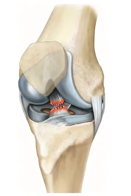 Симптомы и варианты лечения разрыва крестообразных связок
