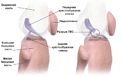 Разрыв передней крестообразной связки колена