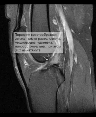 Расшифровка МРТ коленного сустава. Горизонтальный разрыв заднего рога  медиального мениска. Частичный субтотальный разрыв передней крестообразной  связки | Второе мнение