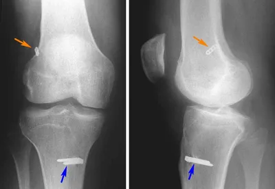 Вывих коленного сустава с разрывом связок | Пикабу