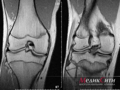 Артроскопическая пластика связок коленного сустава в Москве, цены,  консультация врача-травматолога| Клиника «Ваш Доктор»