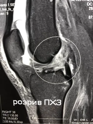 МРТ суставов: плечевого, коленного и др. МРТ связок