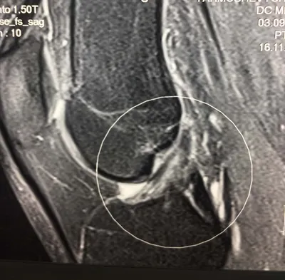 МРТ коленного сустава в Москве: цены, сделать МРТ мениска и колена (связок,  сухожилий) недорого | Центр Дикуля | Центр Дикуля