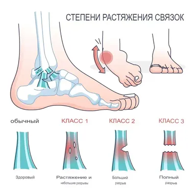 Растяжение связок коленного сустава – симптомы, причины, лечение.