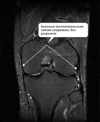 Разрыв мениска: причины, симптомы и лечение всех видов заболеваний в ФНКЦ  ФМБА