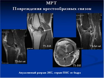 Растяжение коленного сустава у взрослых: симптомы, причины, лечение,  профилактика в домашних условиях