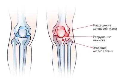 Повреждения связок коленного сустава - признаки, причины, симптомы, лечение  и профилактика - iDoctor.kz