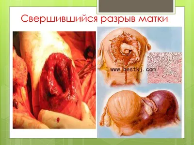разошлись швы после родов — 25 рекомендаций на Babyblog.ru