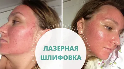 Лазерная Шлифовка CO2•Лазерная эпиляция Candela•RF-лифтинг (@dr.kurkieva) •  Instagram photos and videos