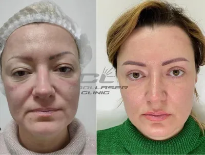 SMAS-лифтинг век: цены в Москве | СМАС-лифтинг вокруг глаз в клинике  BeautyWay Clinic