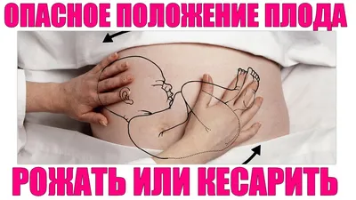 Кто вдоль, кто поперек: когда предлежание плода — это проблема - Parents.ru  | PARENTS