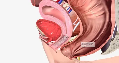 Степень 1 обычно используется для описания ректоцеле, когда прямая кишка  только начала отекать от задней стенки влагалища. | Премиум Фото