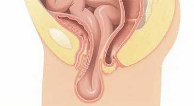 Операция удаление ректоцеле прямой кишки - клиника в Москве | Юсуповская  больница
