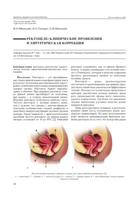 dr.yuldashev - РЕКТОЦЕЛЕ Ректоцеле - выпячивание передней стенки прямой  кишки в заднюю стенку влагалища. Считается одним из частых видов тазового  пролапса и встречается у 5,7% женщин в менопаузе. Ректоцеле возникает у  женщин