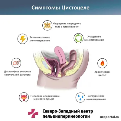 Опущение влагалища | Коррекция интимной проблемы в клинике профессора  Блохина