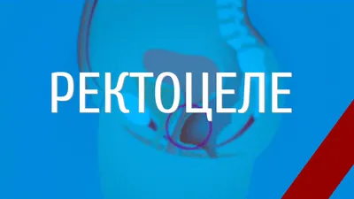 Вагинальный набор ректоцеле Duzey SVT rectocele (ID#1468702575), цена: 7850  ₴, купить на Prom.ua