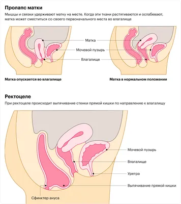 МЕДИЦИНСКИЙ ЦЕНТР АВИЦЕННА on Instagram: \"🔵Ректоцеле— патология,  развивающаяся у женщин разных возрастных групп при выпячивании стенки  прямой кишки по направлению к влагалищу. Заболевание развивается из-за  пролапса органов мочеполовой системы, который ...