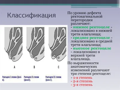 Способ лечения ректоцеле. Патент № SU 1475607 МПК A61B17/00 | Биржа  патентов - Московский инновационный кластер