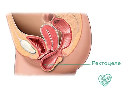 Лечение ректоцеле – операция в Москве | «Бест Клиник»