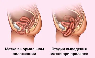 Ректоцеле — опущение прямой кишки в сторону лобковой кости, то есть в  заднюю стенку влагалища. Так называемый карман выпячивается во… | Instagram