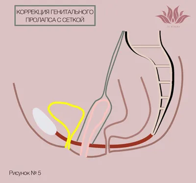 Пластика влагалища — лечение по выгодным ценам Доктор Титов Денис Сергеевич