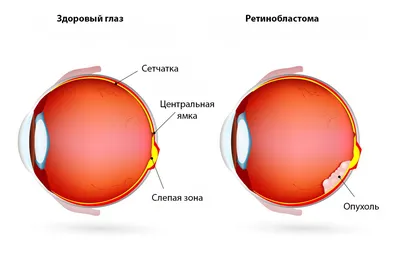 Ретинобластома Инфо
