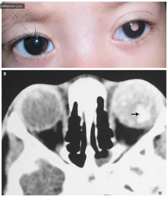 Ретинобластома фото