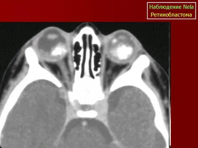 Случай неонатальной бинокулярной ретинобластомы – тема научной статьи по  клинической медицине читайте бесплатно текст научно-исследовательской  работы в электронной библиотеке КиберЛенинка