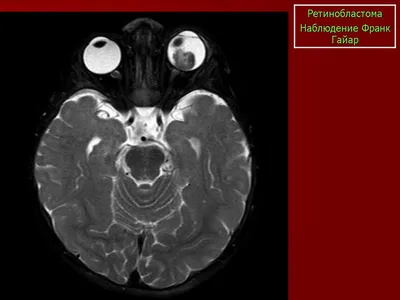 Орбитальная патология. Онк. Ретинобластома, + | Портал радиологов