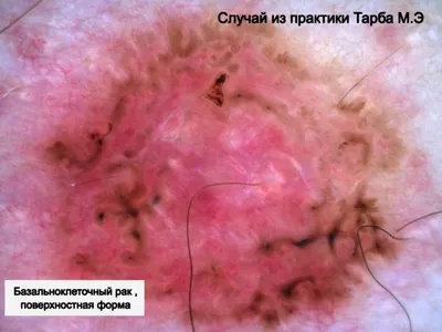 Новые подходы к лечению базалиомы. Клинический случай - hnj.science