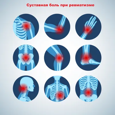 Ревматизм - причины появления, симптомы заболевания, диагностика и способы  лечения