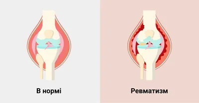 Как диагностировать ревматизм? ~ Ревмопробы