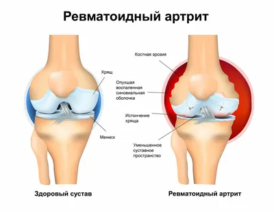 Лечение ревматоидного артрита: симптомы, диагностика, препараты - АКАДЕМФАРМ