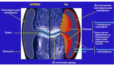 Ревматоидный артрит - современный взгляд на проблему – тема научной статьи  по клинической медицине читайте бесплатно текст научно-исследовательской  работы в электронной библиотеке КиберЛенинка