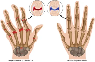Ревматоидный артрит - диагностика и лечение по доступным ценам в Челябинске