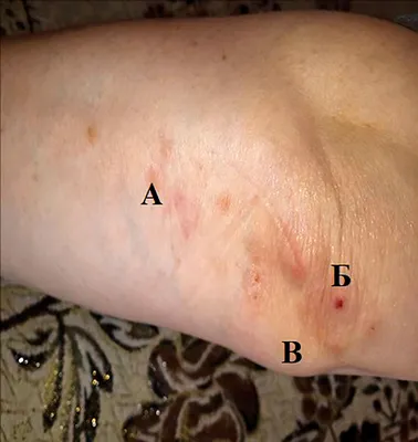 Drug-induced cutaneous vasculitis developing during Etanercept treatment  for rheumatoid arthritis - Chamurlieva - Vestnik dermatologii i venerologii